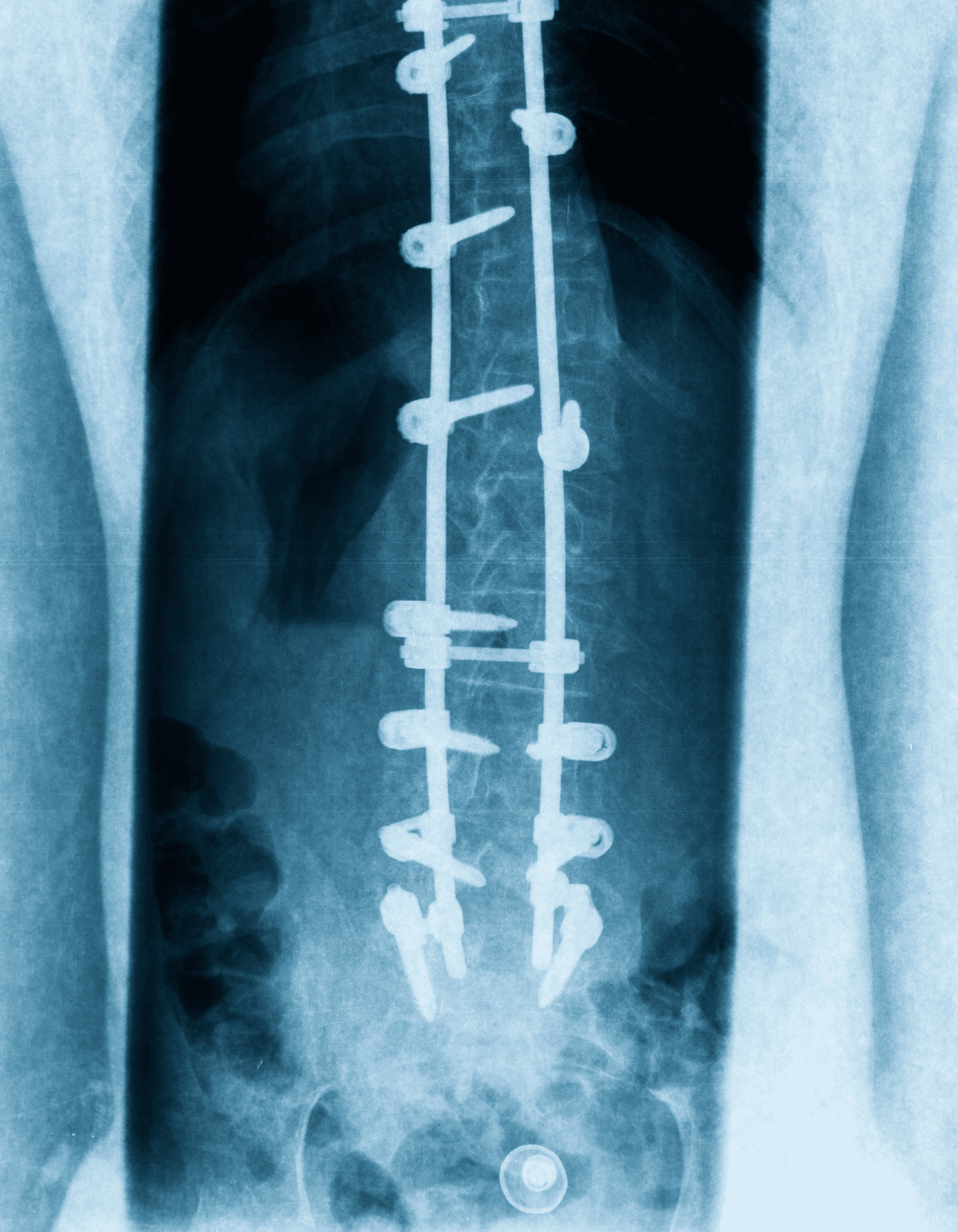 Espondilolistesis e Instrumentación