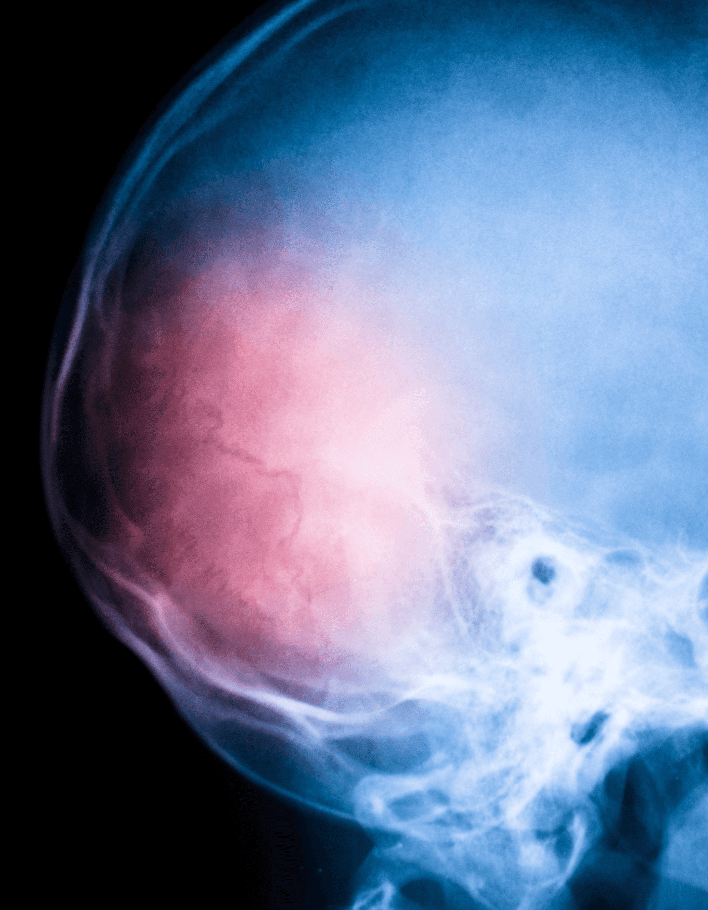 Trauma Craneal Hematoma Subdural