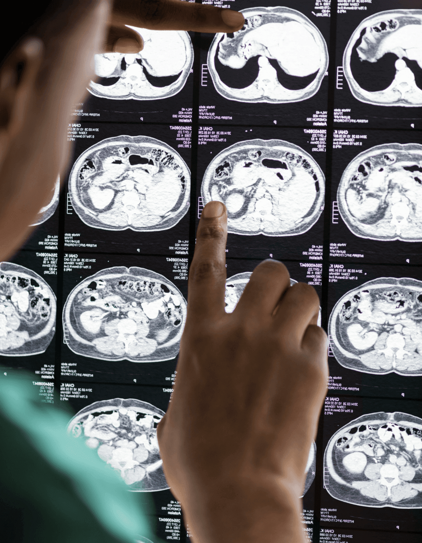 cirugia-de-tumores-cerebrales